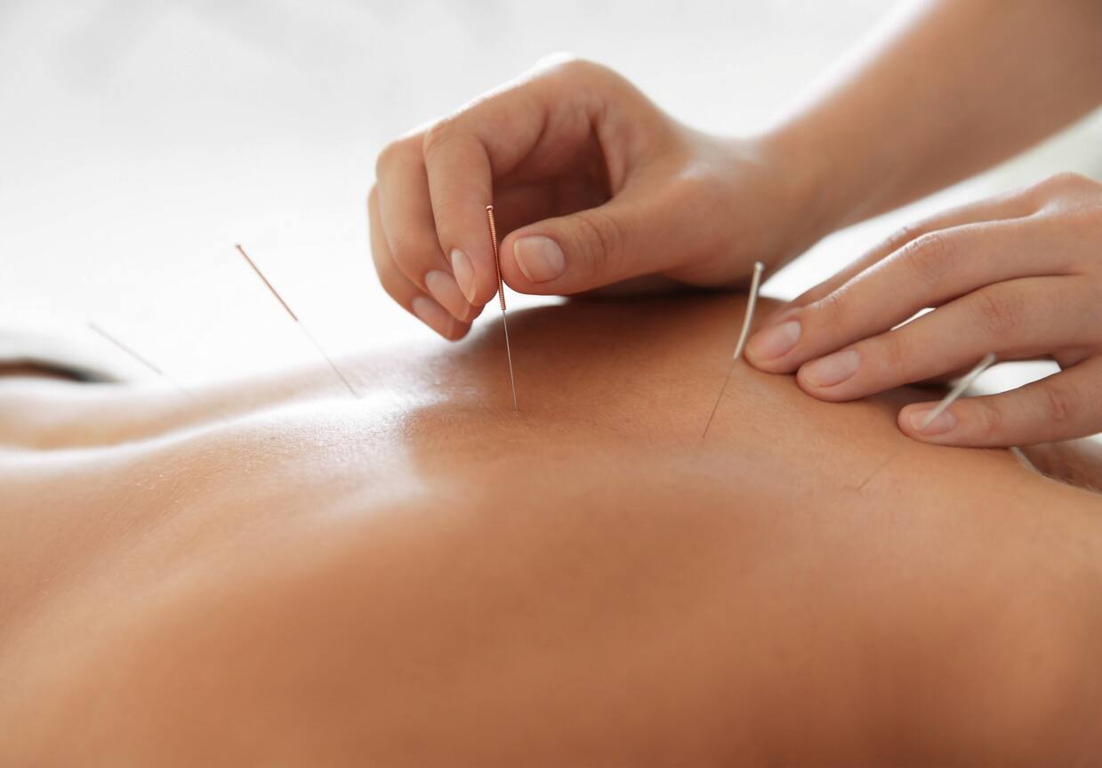 Acupuncture